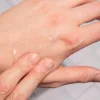 RejuvaSil hegkezelő szilikonos gél (30ml)