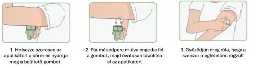 MicroTech LinX CGM folyamatos vércukorszint mérő csomag (2db)
