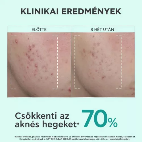 Apivita Just Be Clear szérum bőrhibák ellen (30ml)