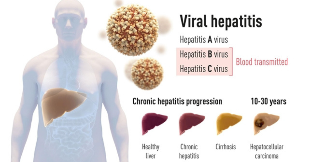 A hepatitis C-vírus felfedezéséért nyerték el idén az orvosi Nobel-díjat